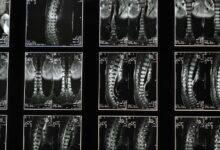 cbd for sciatica relief