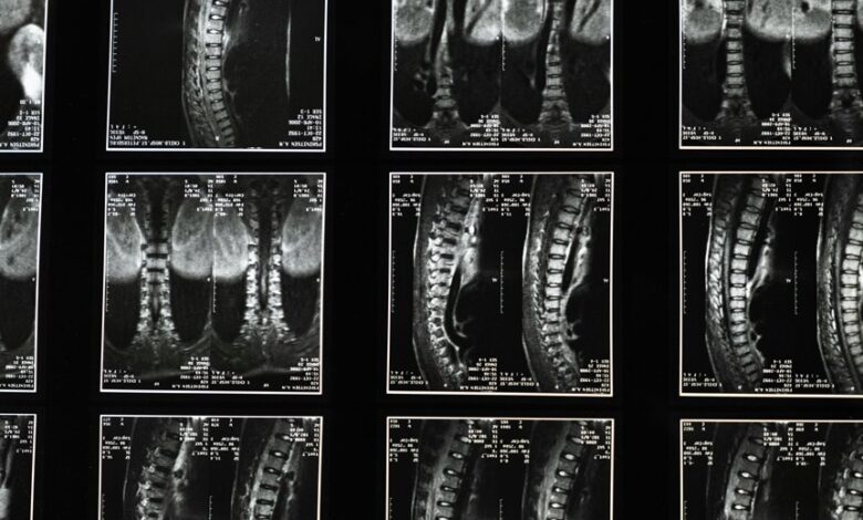 cbd for sciatica relief